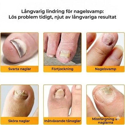 FungalPatch – Kraftfullt nagelvårdsset – Självhäftande svampdödande plåster